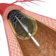 PCI Procedure for Heart Blockage