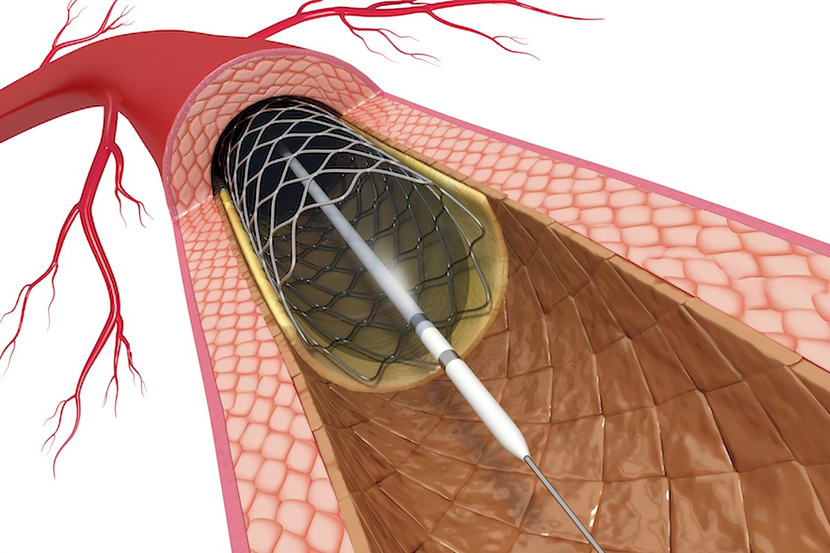 Unclogging Your Arteries: Angioplasty and Stenting Explained