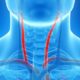 Carotid Artery Treatment for Stroke Prevention