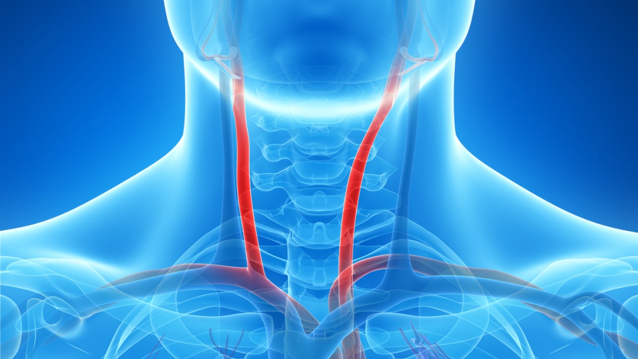 Carotid Artery Blockage: Carotid Endarterectomy vs. Stenting for Stroke Prevention