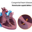 Congenital Heart Defects