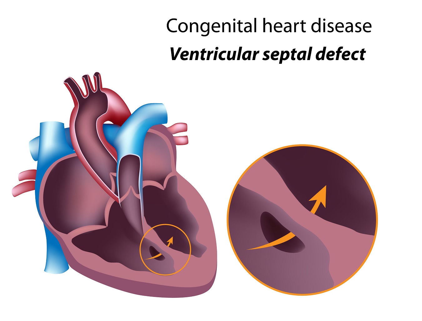 Congenital Heart Defects Explained: Types, Causes, Symptoms & Treatment Options