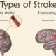 Stroke Types Explained