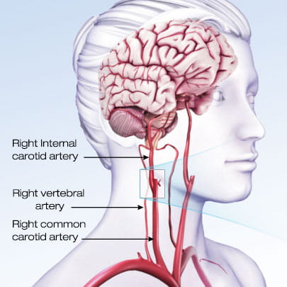 TIA Warning: Don’t Ignore a Mini-Stroke