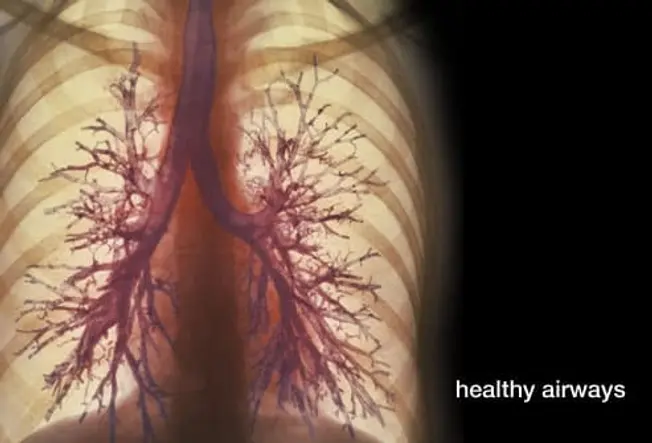 Chronic Bronchitis vs. Emphysema: Unveiling the Different Faces of COPD