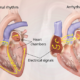 Arrhythmias