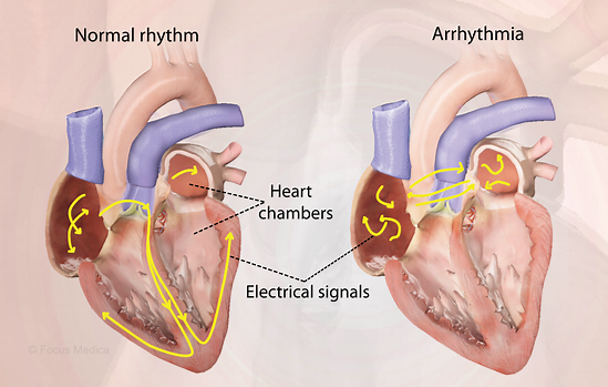 Arrhythmia Explained: Understanding Irregular Heartbeats (Atrial Fibrillation, Ventricular Tachycardia)