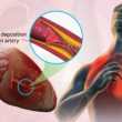 Coronary Artery Disease (CAD)