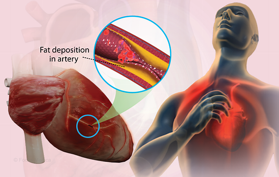 Coronary Artery Disease (CAD): Understanding Symptoms, Causes, and Prevention