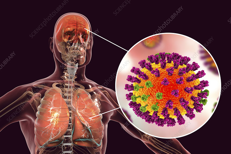 F0223283 Flu complications conceptual illustration