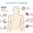 Malaria Symptoms Explained