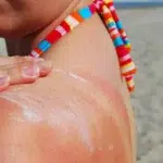 Sunburn Relief: