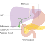 Pancreatic cancer progression and treatment