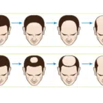 Male hair loss