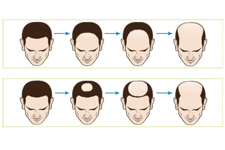 male hair loss progression